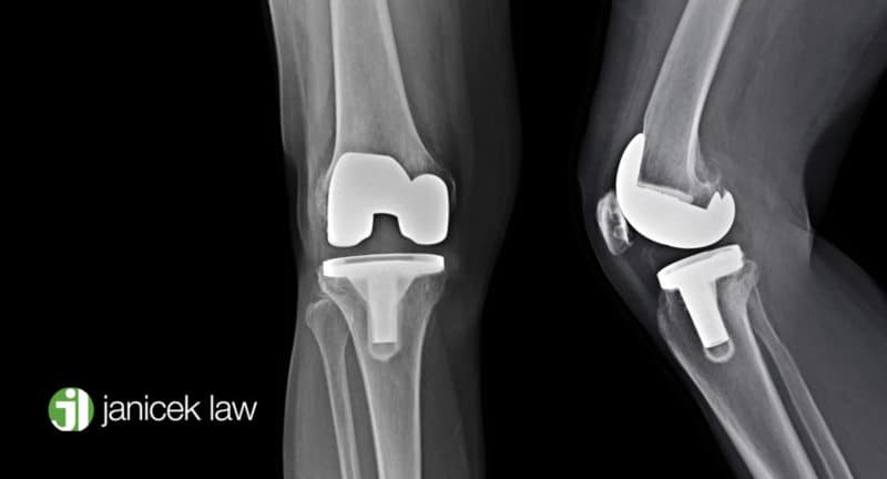 exactech knee recall