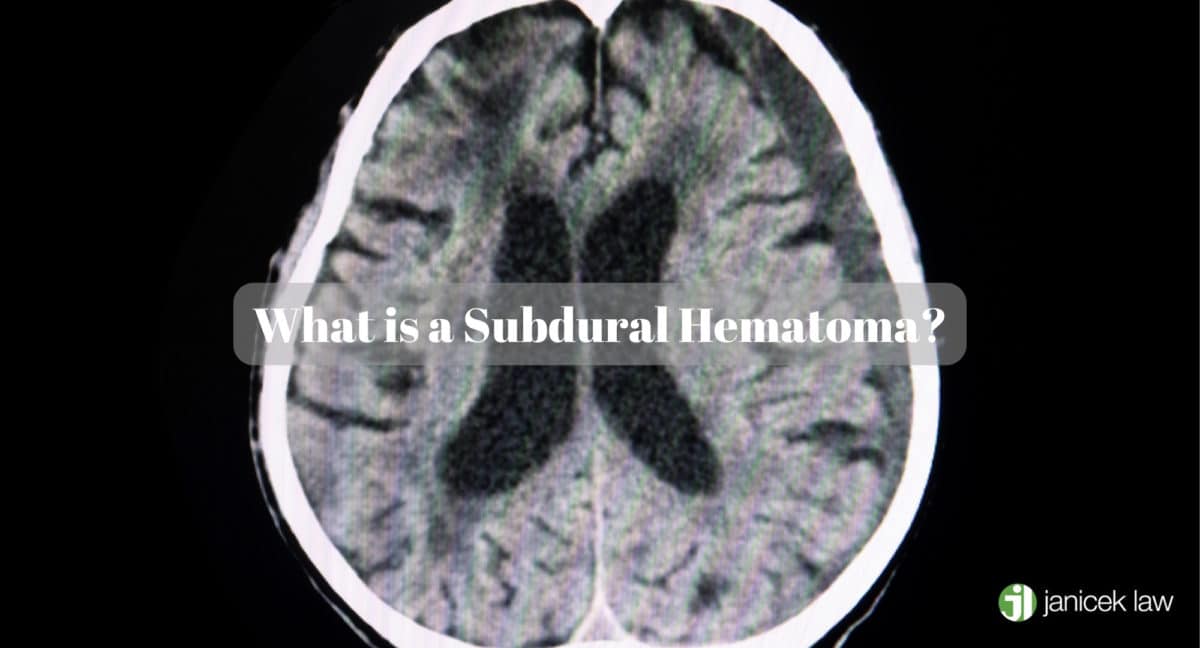 Hematoma subdural