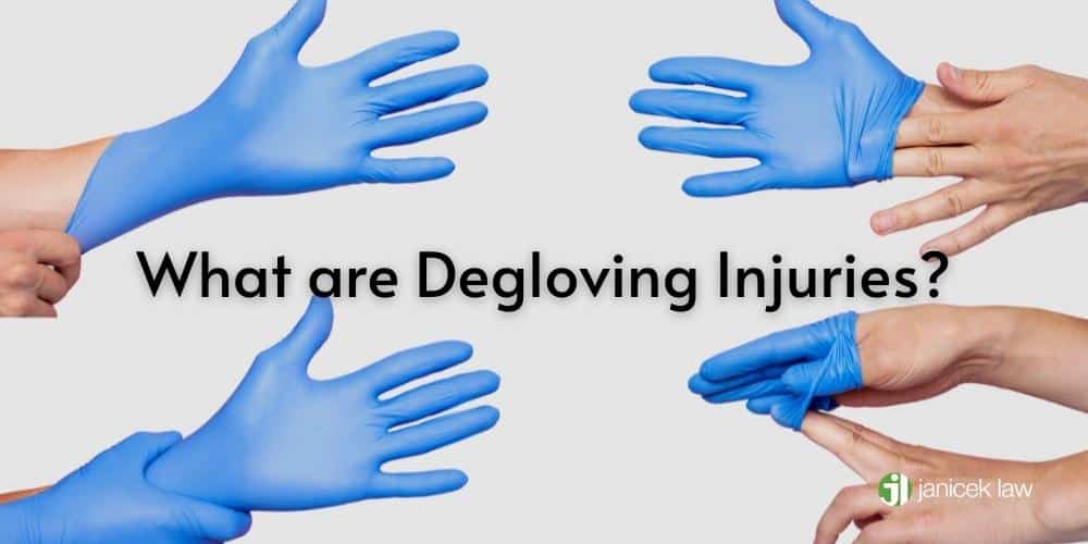 What are Degloving Injuries